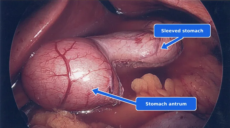 Laparoscopic view of the completed gastric sleeve during the endoscopy check, with the abdomen filled with sterile water