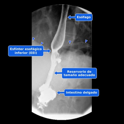Estudio gastrointestinal superior de un bypass gástrico normal con rótulos en español del esófago, esfínter esofágico inferior, reservorio de tamaño adecuado, intestino delgado y borde superior del diafragma