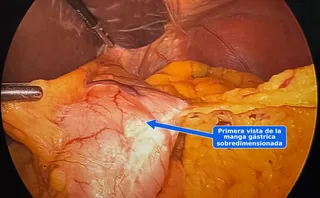 Primera vista laparoscópica de una manga gástrica sobredimensionada antes de convertirla en bypass gástrico, identificada con una flecha azul durante una cirugía de revisión del Dr. Matthew Fitzer.