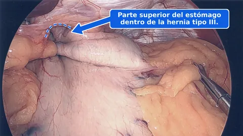 Vista laparoscópica anotada de una hernia hiatal tipo III, con una flecha y una línea punteada que marcan la parte superior del estómago dentro de la hernia.
