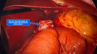 Vista laparoscópica de la revisión de bypass gástrico terminada, con un reservorio de tamaño adecuado reconectado al intestino.
