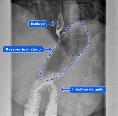 Estudio gastrointestinal superior anotado en español con flechas azules que señalan el esófago y el intestino delgado, y un contorno azul del reservorio dilatado del bypass gástrico