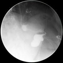 Contrast imaging of a Dr. Fitzer sleeve gastrectomy showing correct narrow diameter along the entire staple line