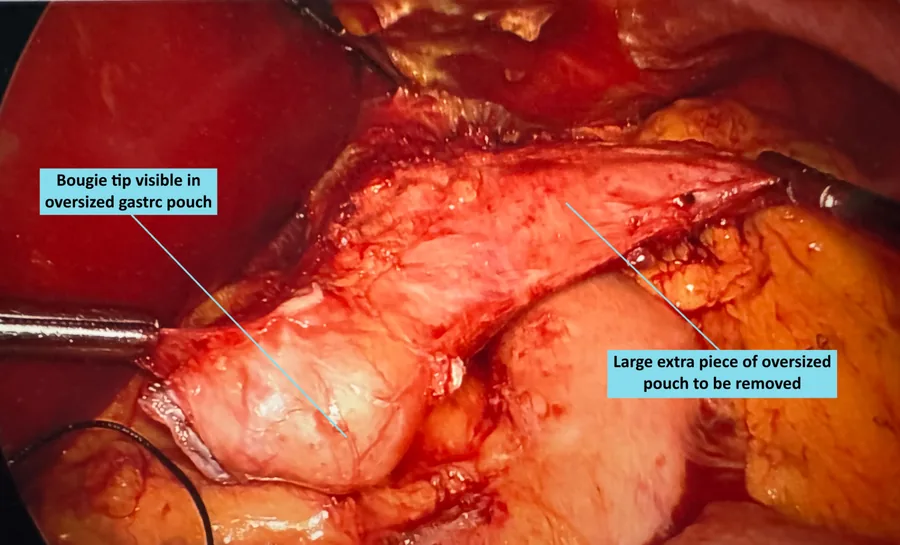 Laparoscopic view of a dilated gastric bypass pouch, with the bougie tip visible inside the oversized pouch and the large extra piece of pouch marked for removal.