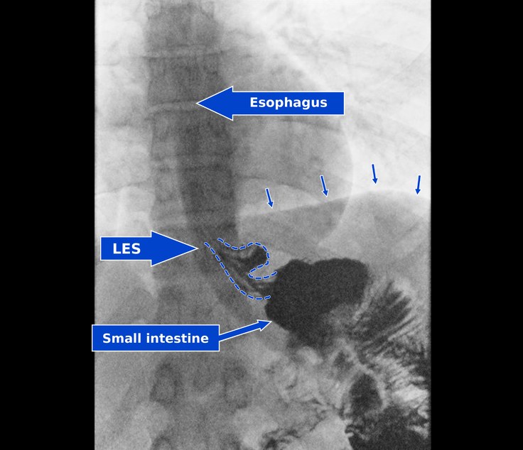 Repeat upper GI series after hiatal hernia repair and conversion to gastric bypass, labeled with the esophagus, lower esophageal sphincter, and small intestine, showing the entire gastric pouch below the diaphragm with no reflux