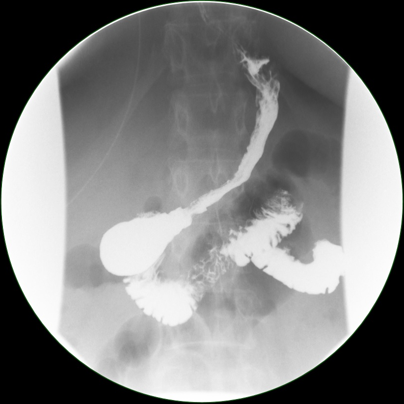 Imaging study of a proper sleeve gastrectomy performed by Dr. Fitzer