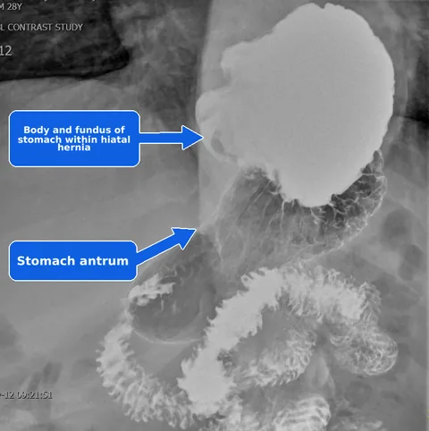Annotated upper GI contrast study showing the body and fundus of the stomach within a giant type IV hiatal hernia, with the stomach antrum below it.