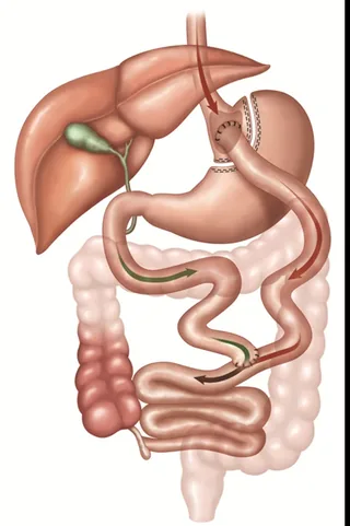 Medical diagram of Roux-en-Y gastric bypass anatomy showing the small pouch and rerouted small intestine