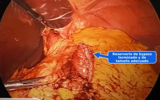 Vista laparoscópica de la bolsa de bypass gástrico terminada y de tamaño correcto tras la conversión de manga a bypass, realizada por el Dr. Matthew Fitzer.