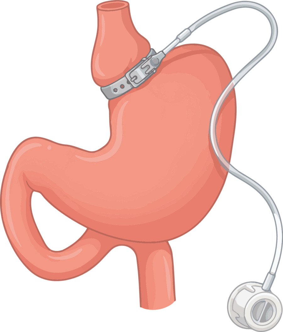 Medical illustration of an adjustable gastric band (LAP-BAND) placed around the top of the stomach with its tubing and fill port