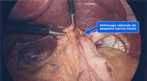 Vista laparoscópica de una hernia hiatal por deslizamiento tipo I ya reparada, con una flecha que señala el estómago que sale de la pequeña hernia hiatal.