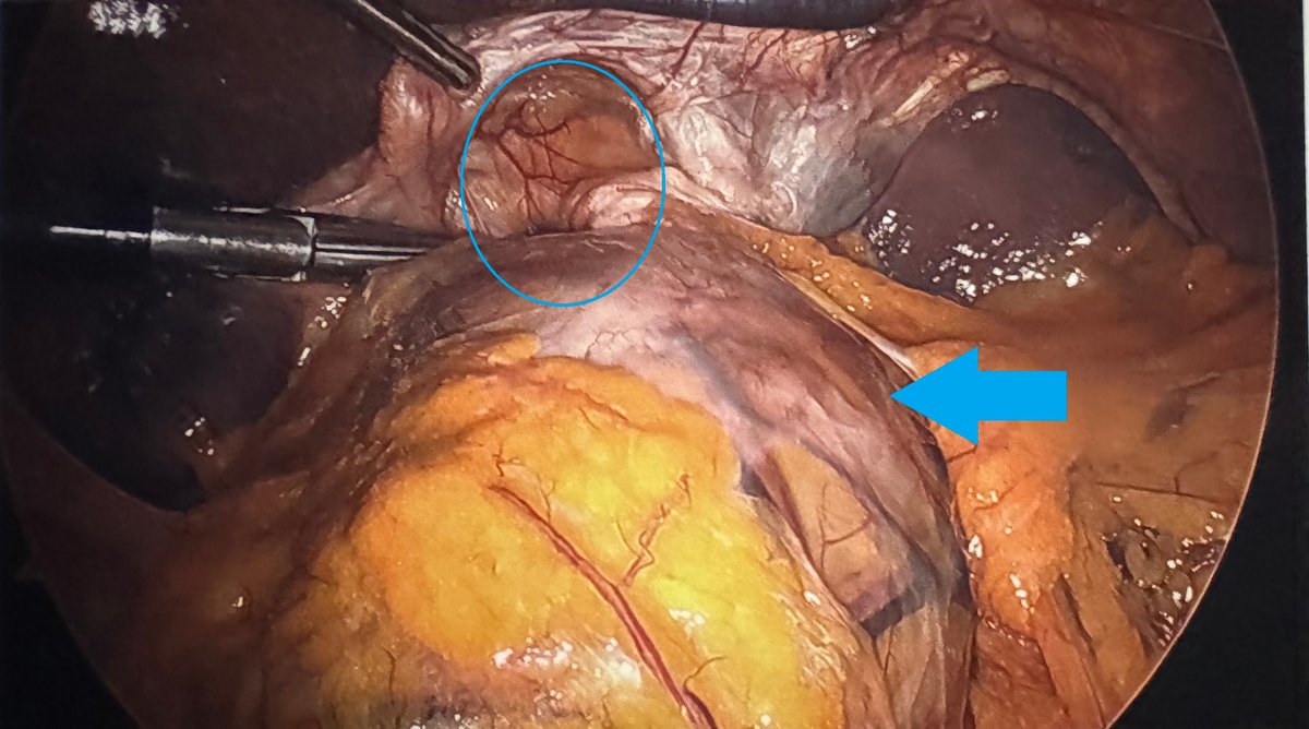 Laparoscopic view before gastric bypass revision showing a dilated pouch marked with a blue arrow and a large hiatal hernia marked with a blue circle