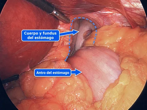 Vista laparoscópica anotada que muestra la mayor parte del estómago y el epiplón de un paciente de 29 años dentro de una gran hernia hiatal tipo IV antes de la reparación.
