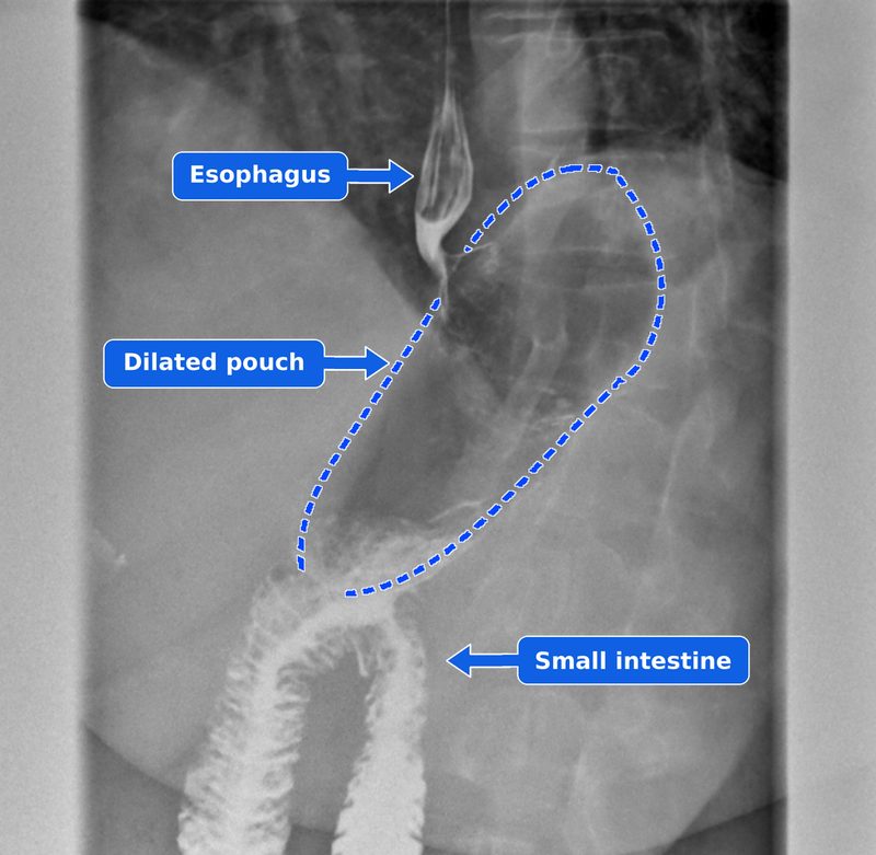 Upper GI contrast study annotated by Dr. Fitzer with blue arrows for the esophagus and small intestine and a blue dashed outline of the dilated gastric bypass pouch