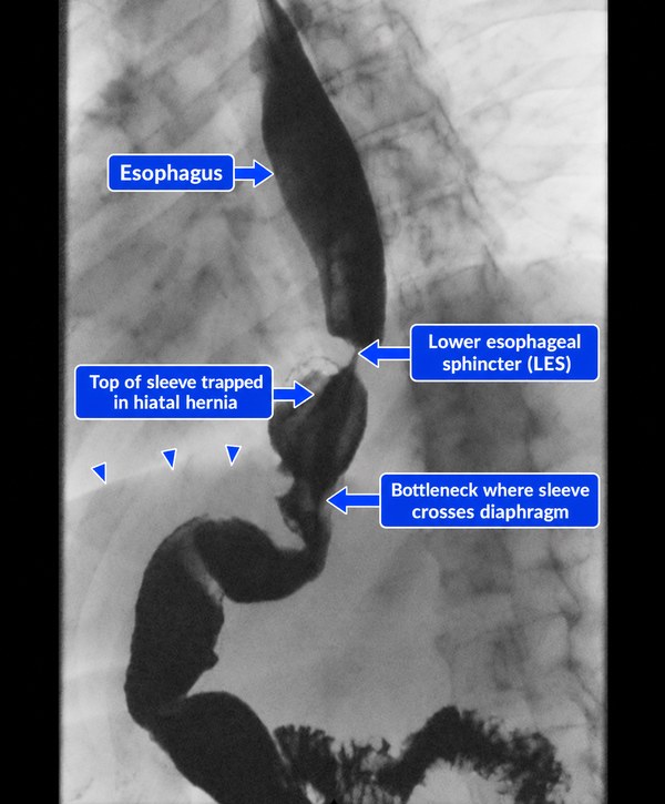 Annotated upper GI contrast study of a sleeve patient with a small hiatal hernia: the sleeve narrows where it crosses the diaphragm, with triangles marking the diaphragm's upper edge.