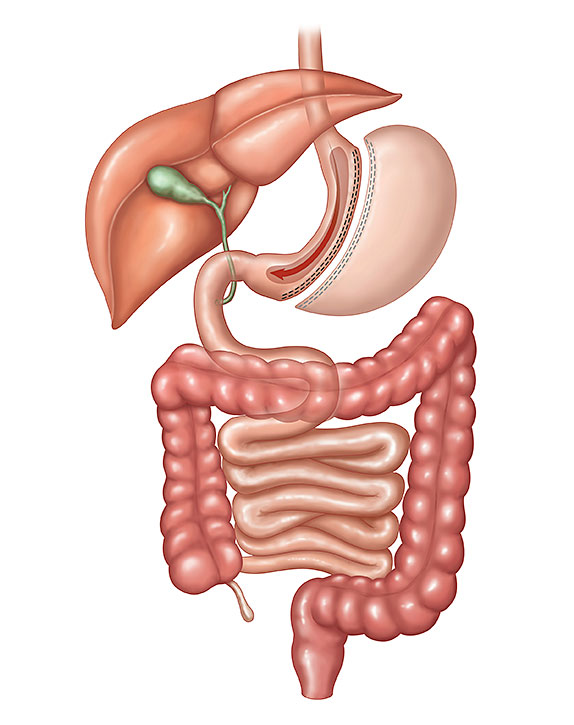 Illustration of a sleeve gastrectomy showing the banana-shaped stomach tube left after 80% of the stomach is removed