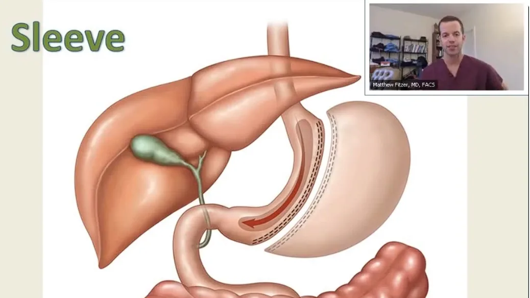 Gastric sleeve procedure webinar with Dr. Fitzer