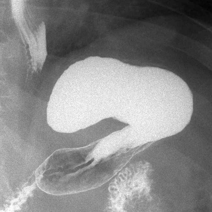 Imaging study of an over-large amateur sleeve gastrectomy
