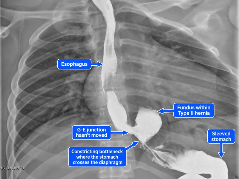 Annotated upper GI series after sleeve gastrectomy showing a type II hiatal hernia, with the esophagus, unmoved gastroesophageal junction, herniated fundus, and sleeved stomach labeled.