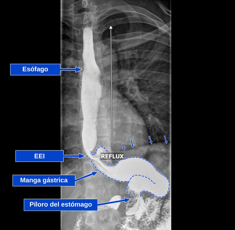 Serie gastrointestinal superior de un paciente con manga gástrica con una hernia hiatal pequeña y reflujo grave, con rótulos para el esófago, el esfínter esofágico inferior, la manga y el píloro, que muestra contraste y una pequeña porción de la manga por encima del diafragma