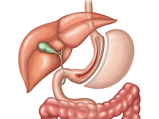 Medical illustration of sleeve gastrectomy showing the reduced stomach sleeve