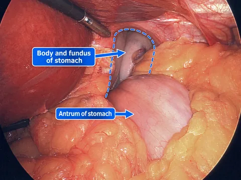Annotated laparoscopic view showing most of a 29-year-old patient's stomach and omentum within a large type IV hiatal hernia before repair.