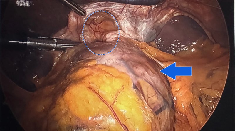 Laparoscopic view before gastric bypass revision showing a dilated pouch marked with a blue arrow and a large hiatal hernia marked with a blue circle