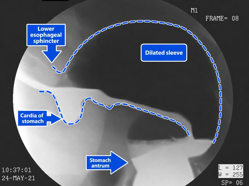 Upper GI series of a dilated gastric sleeve after surgery performed in Mexico, distended with gas from effervescent crystals and annotated with labels for the lower esophageal sphincter, cardia, stomach antrum, and the dilated sleeve