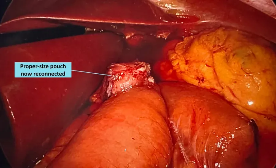 Laparoscopic view of the finished gastric bypass revision showing a proper-size gastric pouch reconnected to the intestine.