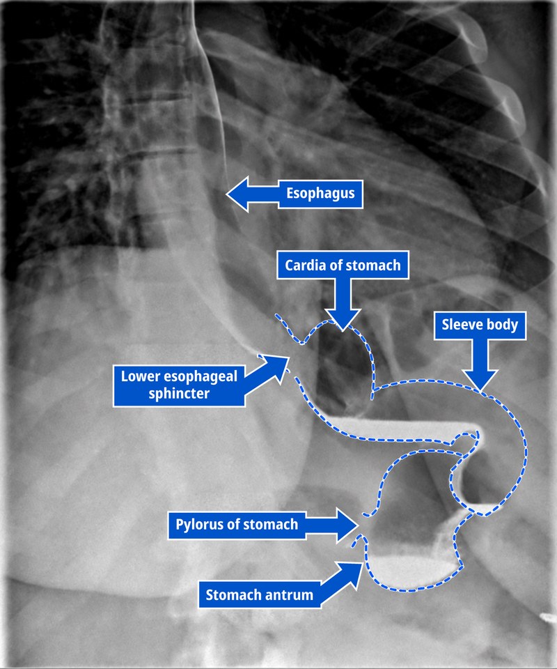 Upper GI series of a normally sized gastric sleeve in a Dr. Fitzer patient, distended with gas from effervescent crystals and annotated with labels for the esophagus, lower esophageal sphincter, cardia, sleeve body, pylorus, and stomach antrum