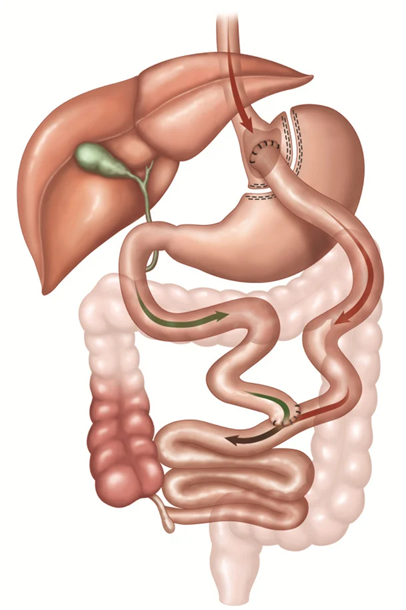 Medical diagram of Roux-en-Y gastric bypass anatomy