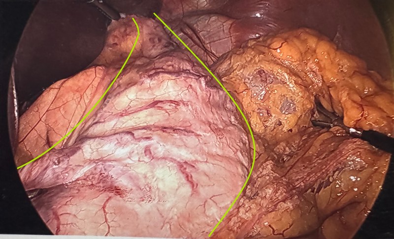 Laparoscopic view of a severely stretched gastric sleeve outlined in green four years after sleeve surgery performed elsewhere