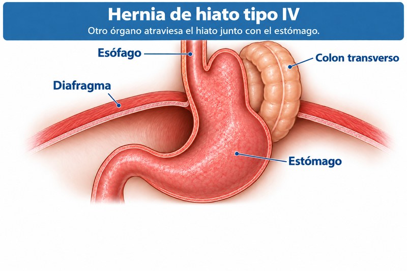 Ilustración médica de una hernia hiatal tipo IV: el estómago y un asa del colon transverso se hernian a través del diafragma.