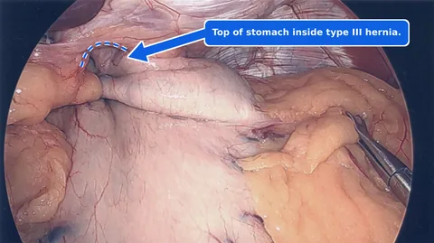 Annotated laparoscopic view of a type III hiatal hernia, with an arrow and dashed line marking the top of the stomach inside the hernia.