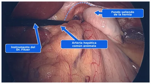 Vista laparoscópica antes de la reparación de una hernia hiatal tipo II, con el fondo del estómago que sale de la hernia y una arteria hepática común anómala señalados.