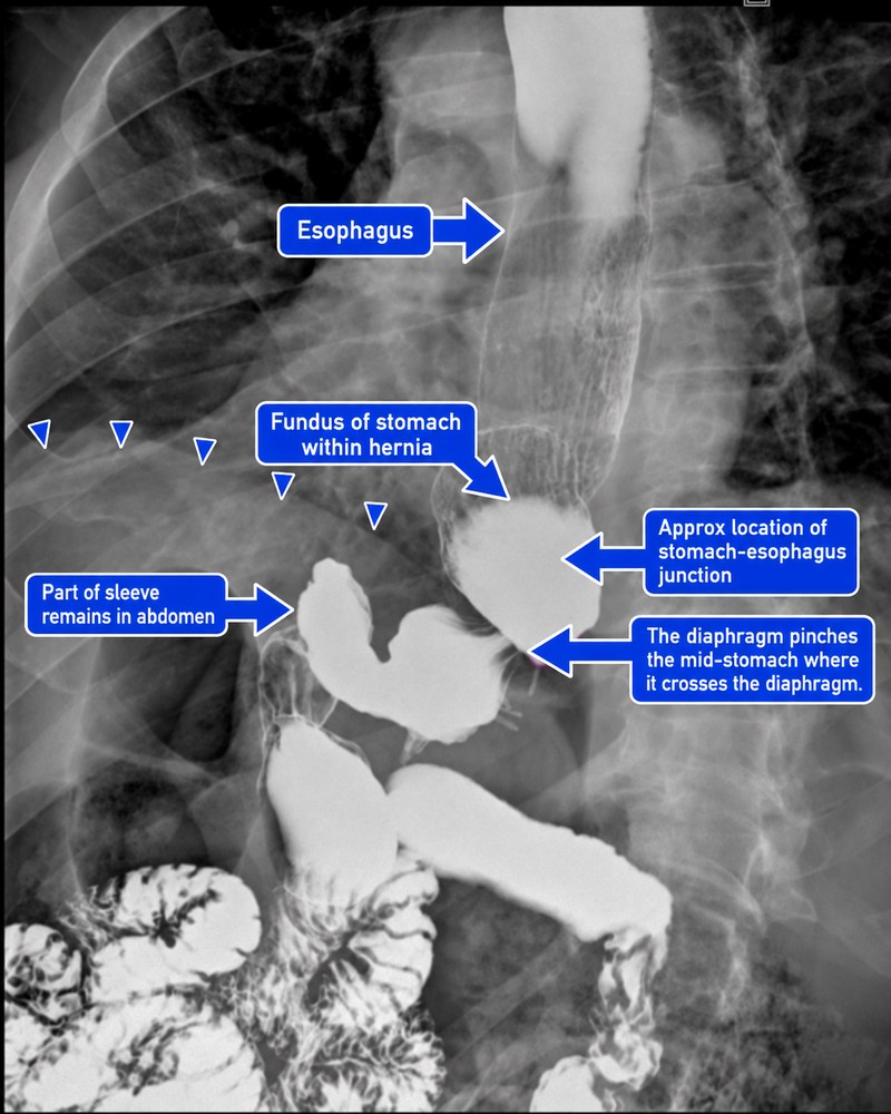 Annotated upper GI study of another sleeve patient with a type III hiatal hernia, showing the esophagus, herniated stomach fundus, approximate gastroesophageal junction, diaphragm narrowing, and remaining sleeve in the abdomen.