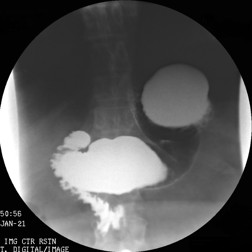 Imaging study of an over-large amateur sleeve gastrectomy