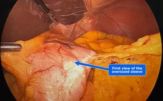 Laparoscopic first view of an oversized gastric sleeve before conversion to gastric bypass, identified by a blue arrow during a sleeve revision by Dr. Matthew Fitzer.