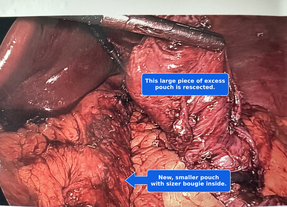 Laparoscopic gastric bypass pouch revision showing the large excess pouch being resected and the new smaller pouch with a sizer bougie inside
