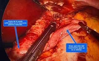 Revisión laparoscópica de la bolsa de bypass gástrico en curso: la sonda calibradora marca el reservorio reducido mientras la engrapadora retira la gran porción adicional.