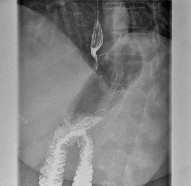 Upper GI contrast study of a dilated gastric bypass pouch filled with gas, with oral contrast mostly passed into the small intestine, twelve years after the original surgery