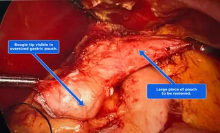 Laparoscopic view of a dilated gastric bypass pouch, with the bougie tip visible inside the oversized pouch and the large extra piece of pouch marked for removal.