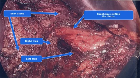 Laparoscopic view of scar tissue covering the crura and esophagus during redo hiatal hernia repair after a prior mesh repair.