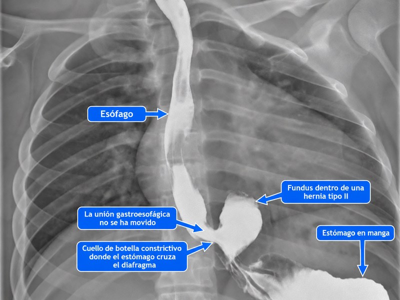 Serie gastrointestinal superior anotada tras una manga gástrica que muestra una hernia hiatal tipo II, con el esófago, la unión gastroesofágica sin desplazamiento, el fundus herniado y el estómago en manga señalados.