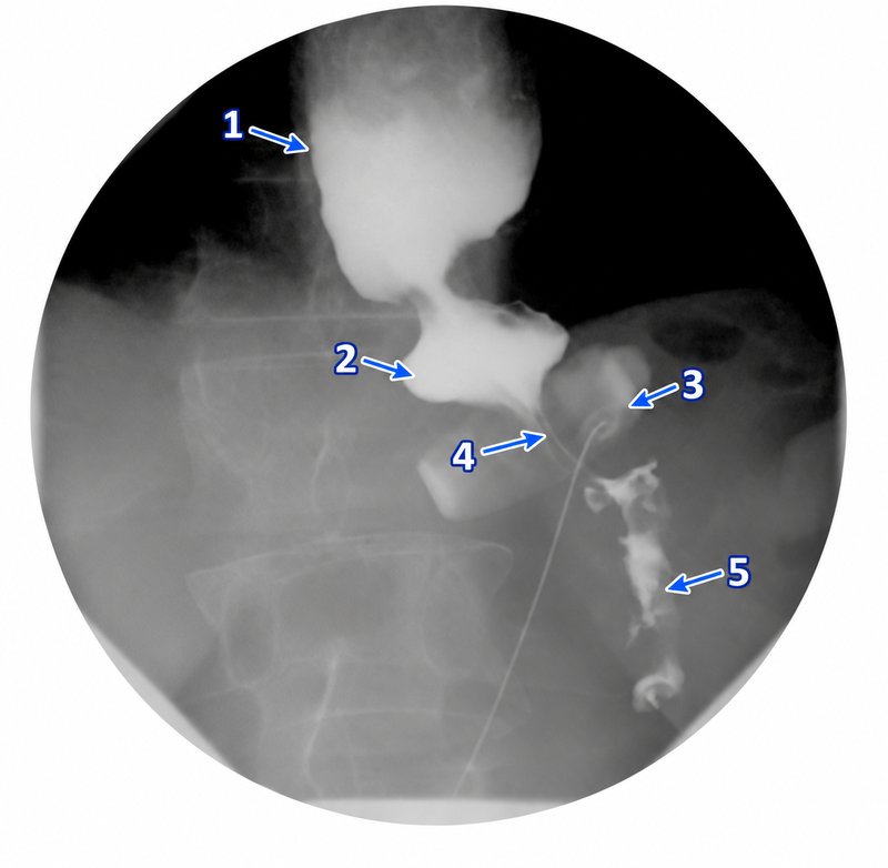 Upper GI contrast study of a LAP-BAND patient showing a dilated esophagus, pouch above the band, narrow contrast passage through the band, and contrast in the stomach