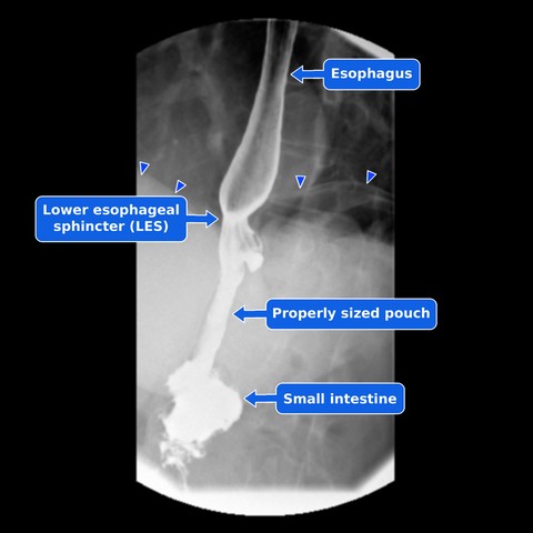 Annotated upper GI study of a normal gastric bypass showing the esophagus, lower esophageal sphincter, narrow pouch, small intestine, and triangles marking the top edge of the diaphragm