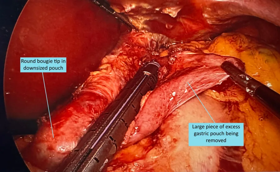 Laparoscopic gastric bypass pouch revision in progress: a bougie sizer marks the downsized pouch while a stapler removes the large excess piece of gastric pouch.