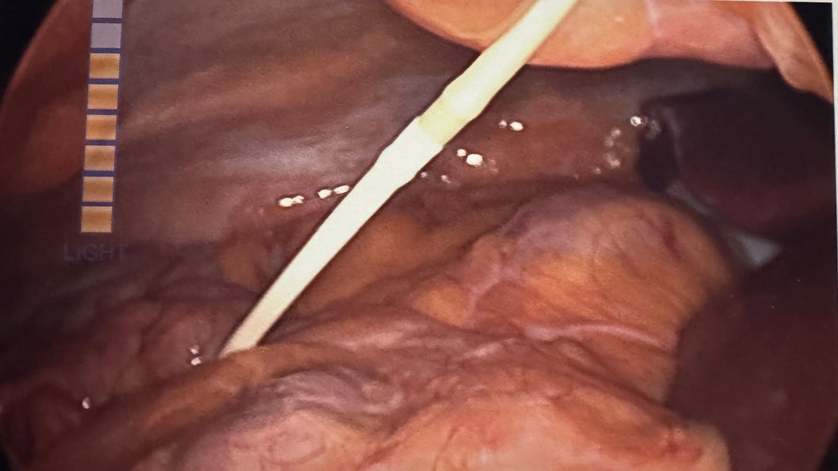 Vista laparoscópica del tubo de una banda gástrica bajo tensión, enredado como una hamaca alrededor de la raíz del intestino delgado, en un paciente con obstrucción intestinal crónica