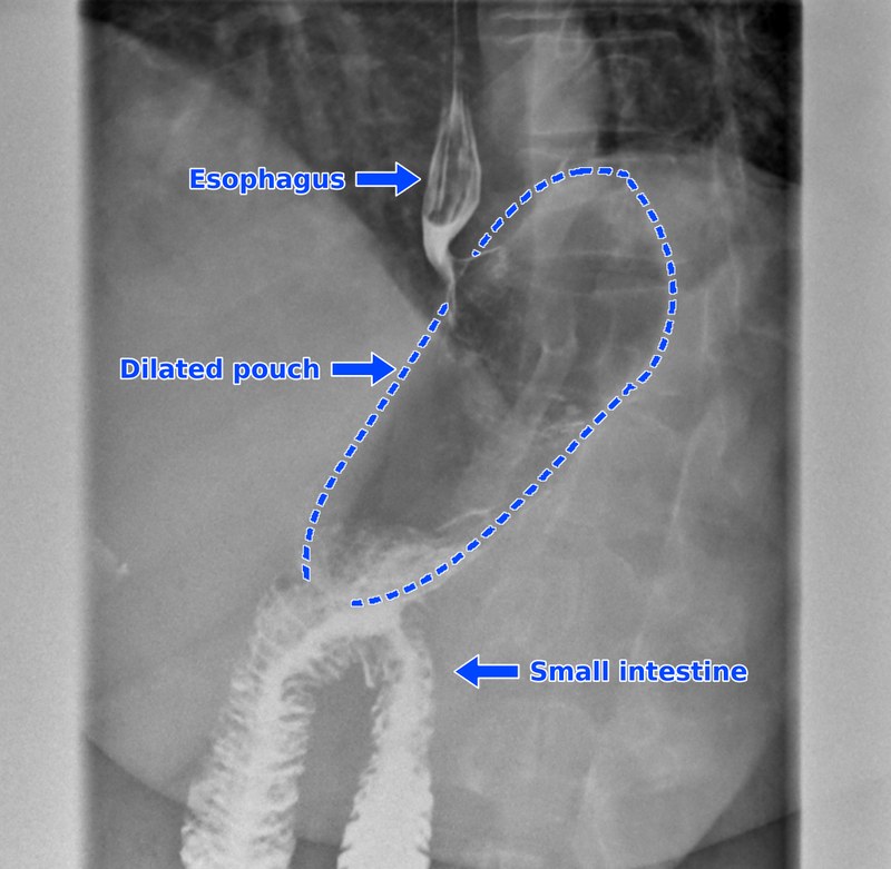 Upper GI contrast study annotated by Dr. Fitzer with blue arrows for the esophagus and small intestine and a blue dashed outline of the dilated gastric bypass pouch