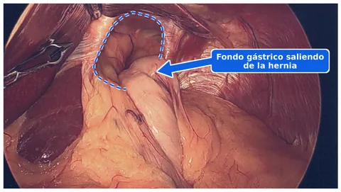 Foto laparoscópica anotada de una hernia hiatal: una línea punteada delinea la abertura de la hernia y una flecha señala el fondo gástrico que sale de la hernia.